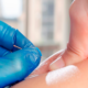 a person getting acupuncture treatment